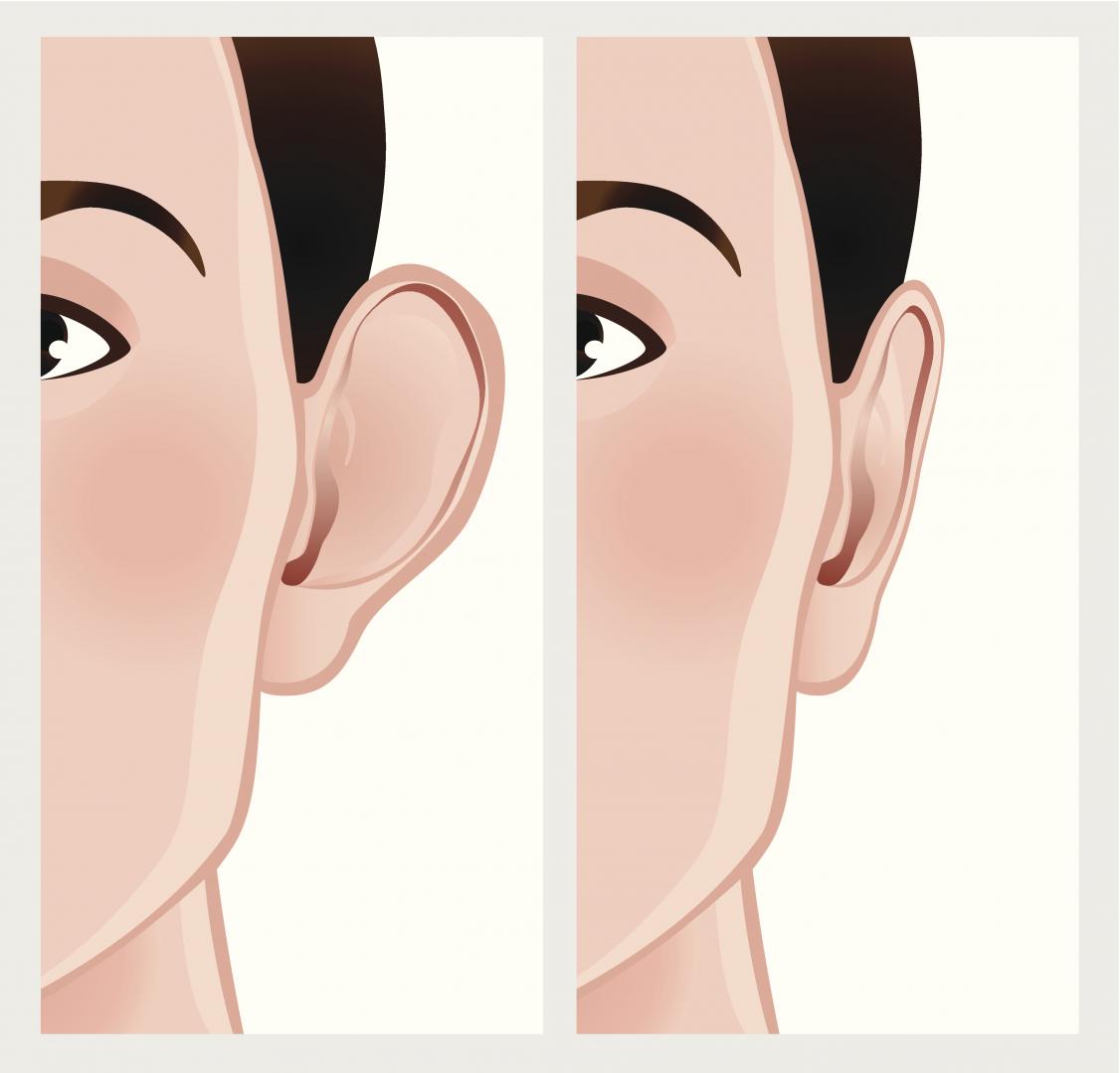 Otoplasti (Kepçe Kulak Ameliyatı)